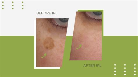 Laser Skin Treatments The Benefits And All The Other Details You Need