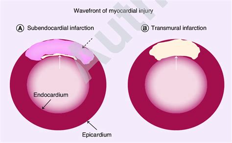 Subendocardial Versus Transmural Myocardial Infarction During A Download Scientific Diagram