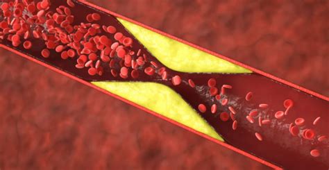 Understanding Peripheral Artery Disease Pad What You Need To Know