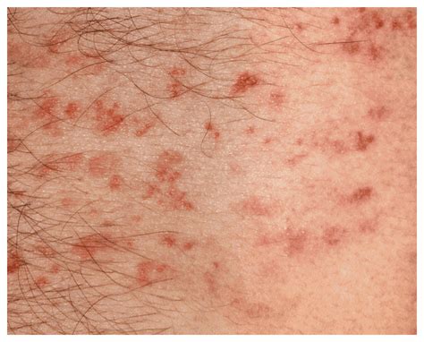 Psoriasis Symptoms | psoriasisSPEAKS