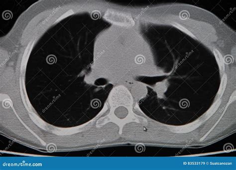 Lung CT stock image. Image of tomography, scan, imaging - 83533179