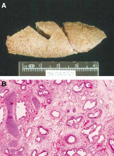 Figure 2 From Congenital Pulmonary Airway Malforma Tion—a New Name For And An Expanded