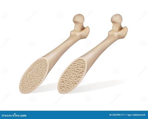 Healthy Bone And Osteoporosis Bone Cartoon Vector CartoonDealer