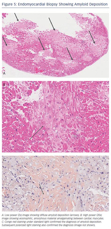 Endomyocardial Biopsy Showing Amyloid Deposition Radcliffe Cardiology