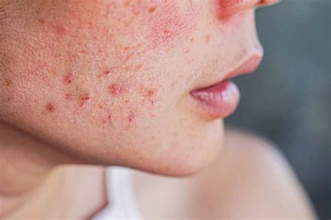 Acne Cistica Come Riconoscerla Curarla E Prevenirla Eucerin