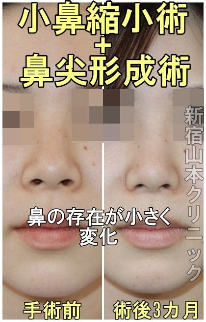 鼻の穴が見えにくく変化 やまくり女子すたっふの美的日常