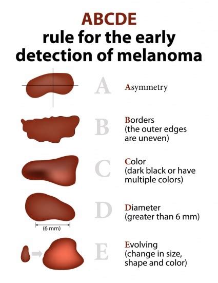 How do I identify a suspicious lesion? | Advanced Dermatology & Skin ...