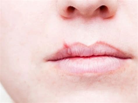 STD On Lips Pictures Causes Treatment STDWatch