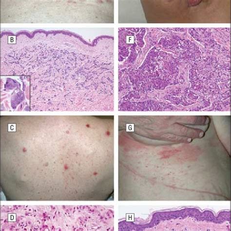 Clinicopathologic Correlation Of Cutaneous Metastases Violaceous Download Scientific Diagram