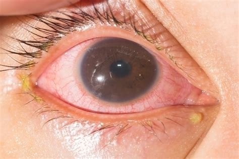 S Ntomas De Conjuntivitis En Adultos Y Beb S Maestria Salud