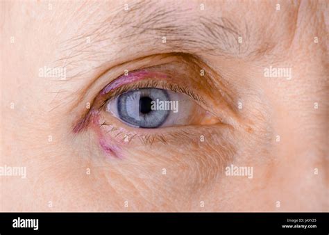 Hematoma hi-res stock photography and images - Alamy