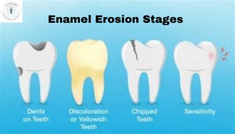 Enamel Erosion Stages