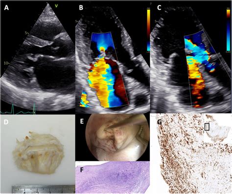 Echocardiogram with parasternal long axis view. Parasternal long axis ...