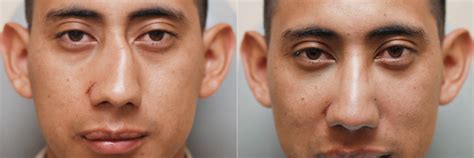 Como Saber Se Quebrei O Nariz - Nariz quebrado: saiba o que fazer em caso de uma fratura nasal