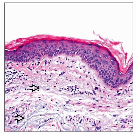 Large Cell Acanthoma | Basicmedical Key