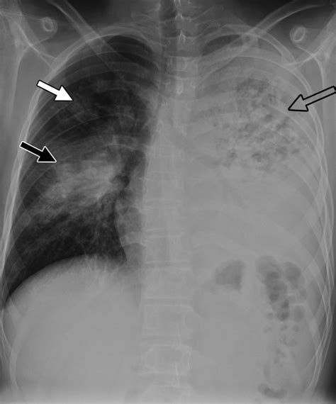 Blastomycosis Lung X Ray