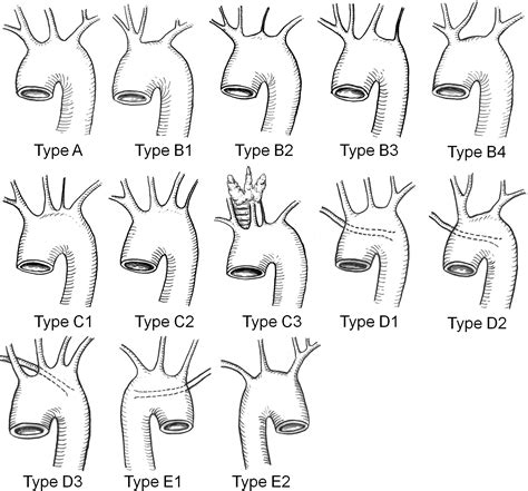 Morphologic features of the aortic arch and its branches in the adult Chinese population ...