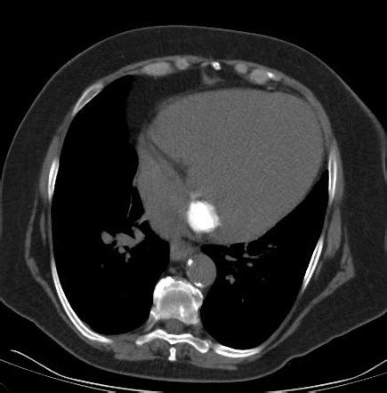 Caseous Mitral Annular Calcification Image Radiopaedia Org