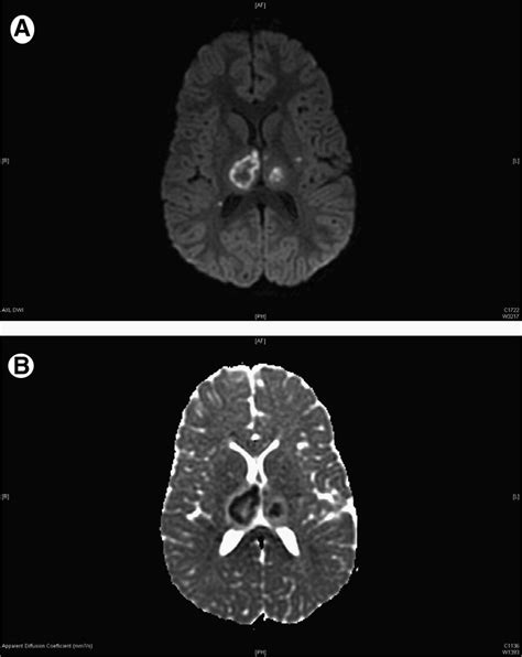 Favorable Outcomes In Acute Necrotizing Encephalopathy In A Child