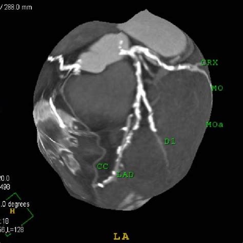 2 D map of coronary arteries: LAD: left descending coronary artery; D1 ...