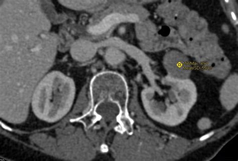 Beautiful Example Of A High Density Renal Cyst Simulating A Papillary Renal Cell Carcinoma