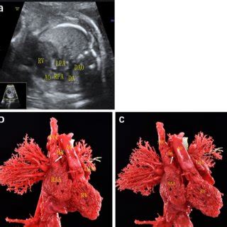 Prenatal Echocardiographic And Cast Demonstration Of A Fetus With