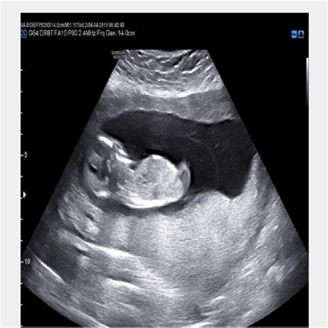 dead fetus   caesarian section entangled  knotted umbilical