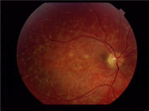 Stgd Macular Atrophy And Flecks At The Posterior Pole Download Scientific Diagram