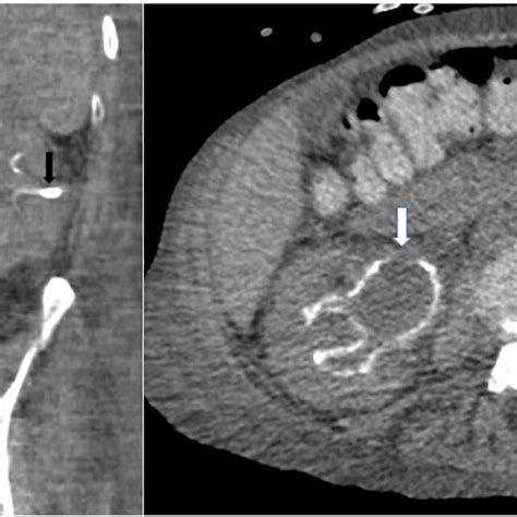 Non Enhanced Ct Scan Showing Encrusted Pyelitis White Arrow Linear