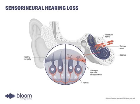 Hearing loss types - The complete guide | bloom hearing