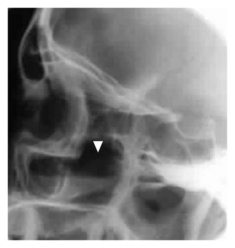 Lateral Plain X Ray Showing Air Fluid Level In The Maxillary Sinus