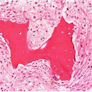 Histopathology Of The Chondrosarcoma Shows The Tumor Cells Permeating