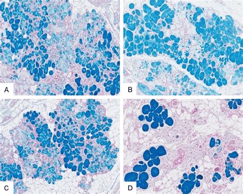 Alcian Blue Staining Of The Herniated Sublingual Gland Slg Alcian