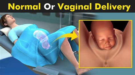 Normal Vaginal Delivery Home