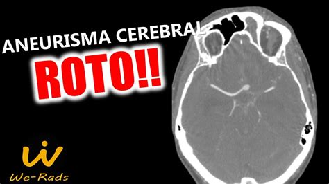 Aneurisma Cerebral Roto Na Tomografia De Cr Nio Youtube