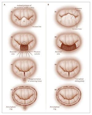 mitral-valve-repair - Heart Surgery Information