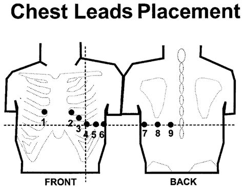 Ekg Leads Placement Diagram - General Wiring Diagram