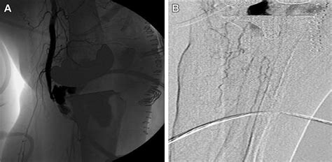 Intraoperative Endovascular Stent Graft Repair Of A Popliteal Artery