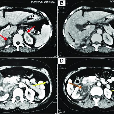 Contrast Enhanced Ct Of The Abdomen Showing Heterogeneously Enhancing