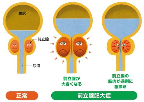 前立腺の病気 やまだ泌尿器科クリニック 内科 豊田市新町