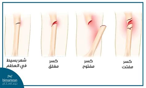 كسور الركبة الأعراض والأنواع مع كيفية العلاج بيمارستان