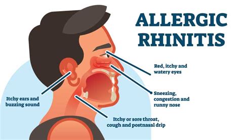 Self Care Tips To Manage Rhinitis Symptoms Dr Batras