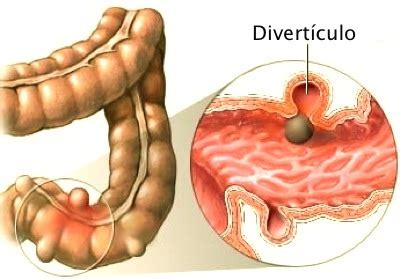 Divertículos del colon | Exploraciones Digestivas Funcionales