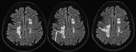 Leucoencefalopatía multifocal progresiva asociada al natalizumab