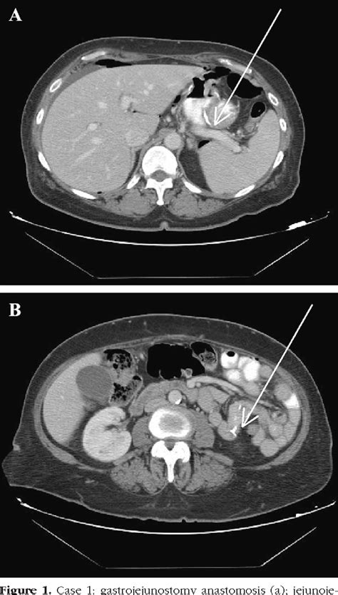 Figure 1 From Laparoscopic Repair Of A Free Perforation Of A Marginal