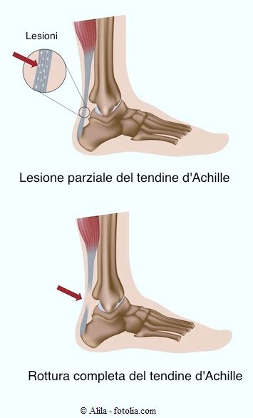 Rottura Del Tendine D Achille Sintomi Intervento Ed Esercizi Di