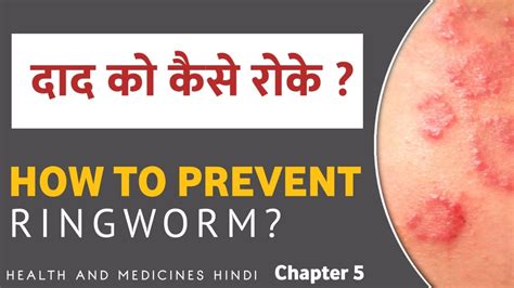 दद क कस रक How To Prevent Ringworm Daad Ko Failne Se Kaise