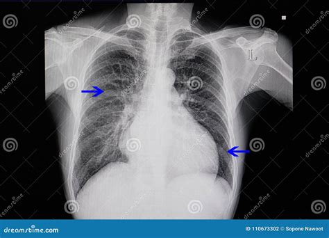 Chest X-ray of a Patient with Heart Failure Stock Photo - Image of ...