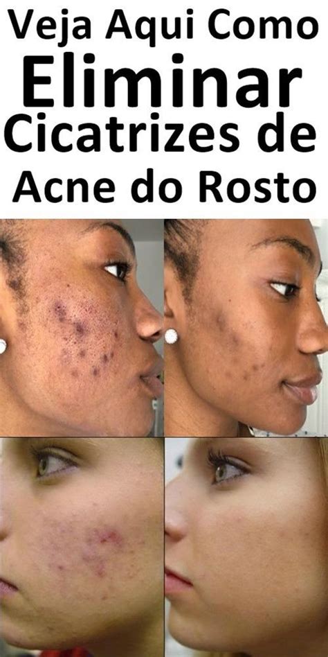 Acabe A Acne Do Rosto Cicatriz De Acne Tirar Manchas De