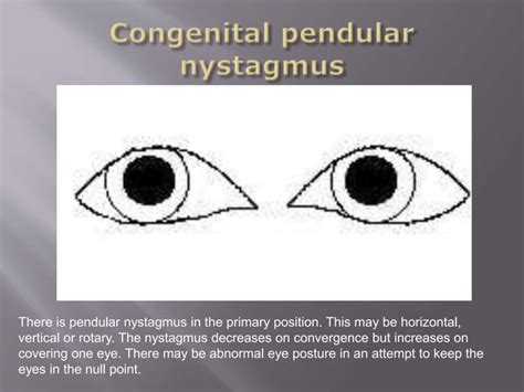 Common Cases: Nystagmus | PPTX | Eye and Vision Conditions | Diseases ...